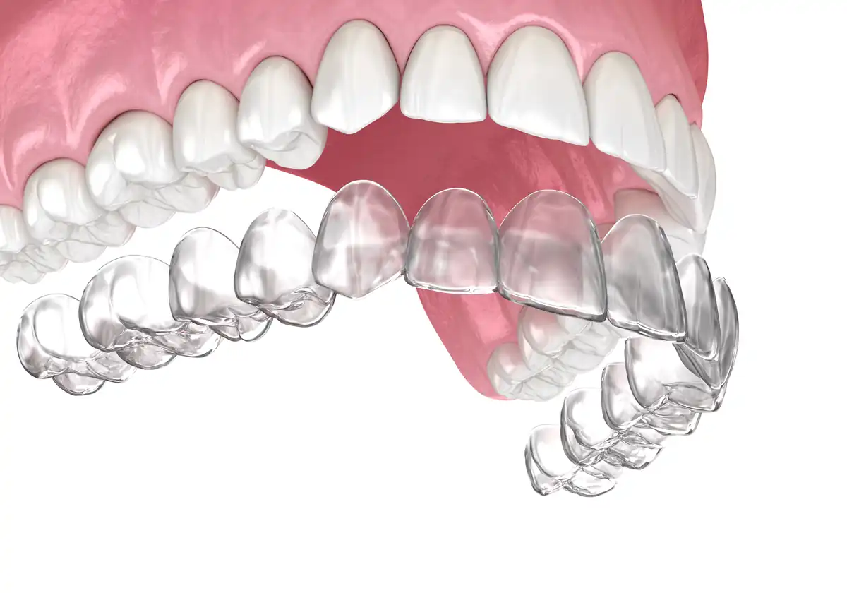 Clear Aligners