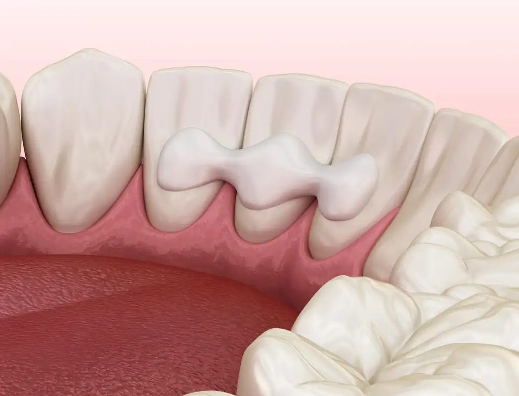 Dental Bonding
