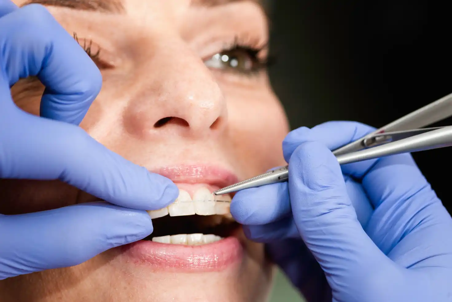 Ceramic Braces